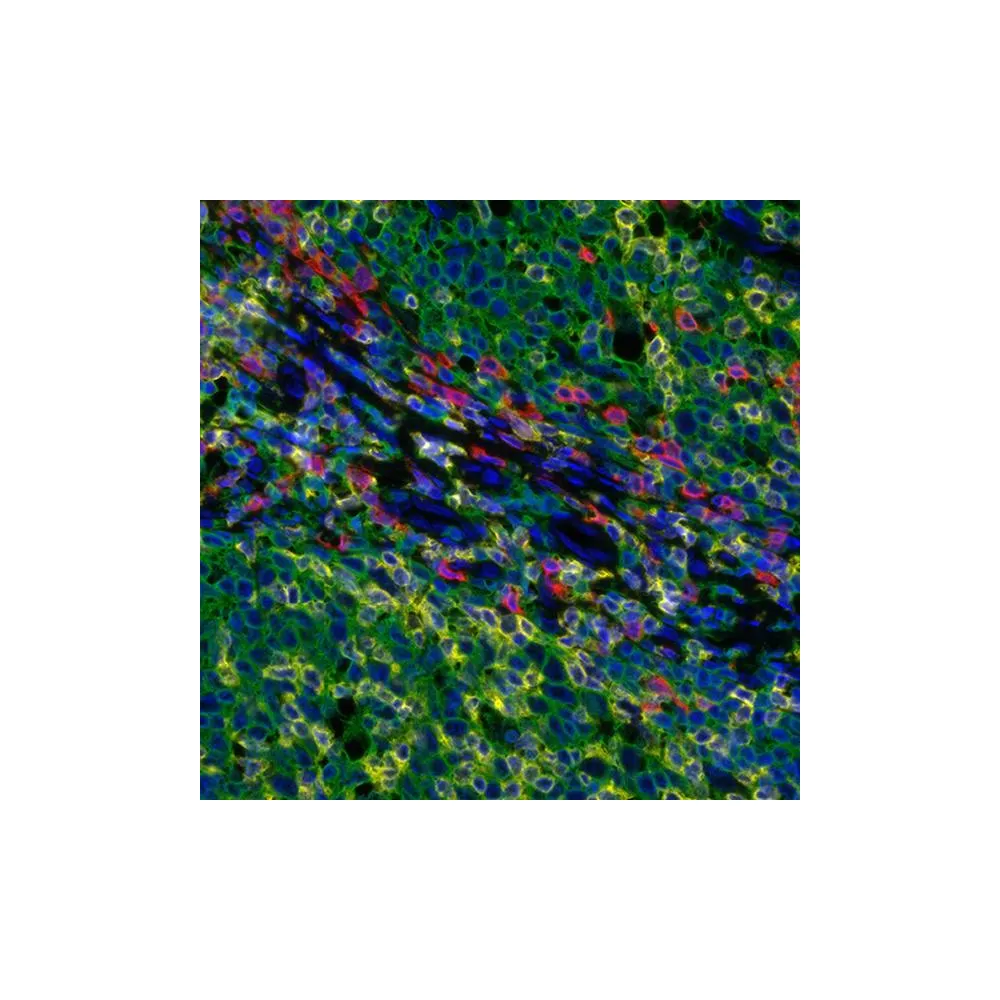 Tumor Infiltrating Lymphocyte (TIL) PathPlex® Panel (CD3E, CD8 alpha, CD20)