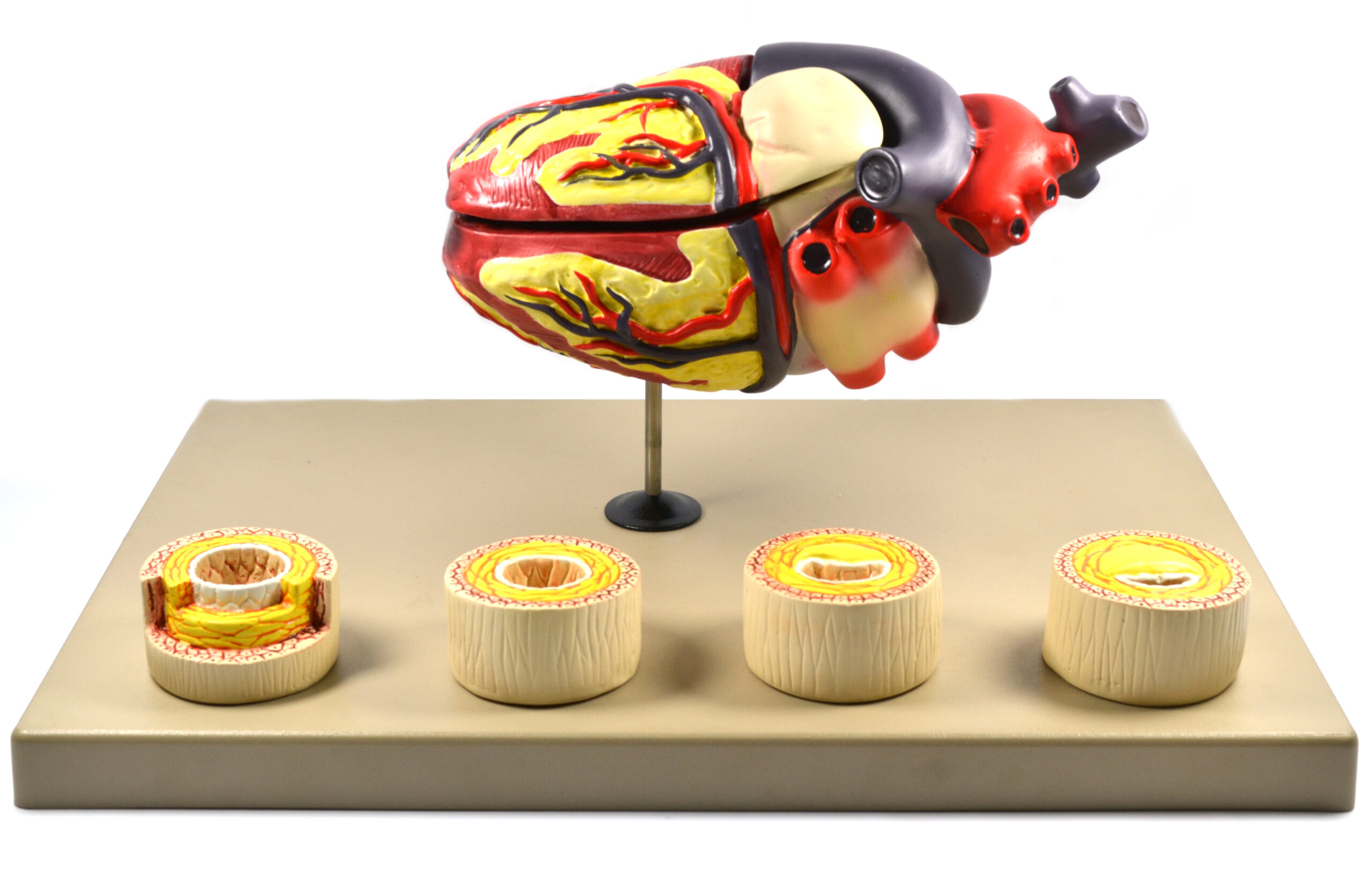 Model of Human Heart Conditions Pathology; Larger than life size (10"); Artery Cross sections 2.5" in diameter