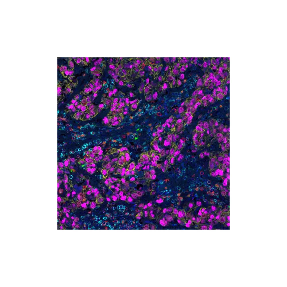 Cell Proliferation and Metastasis PathPlex® Panel (CD3E, Granzyme B, CD8 alpha, Cytokeratin, Ki-67, SOX10)